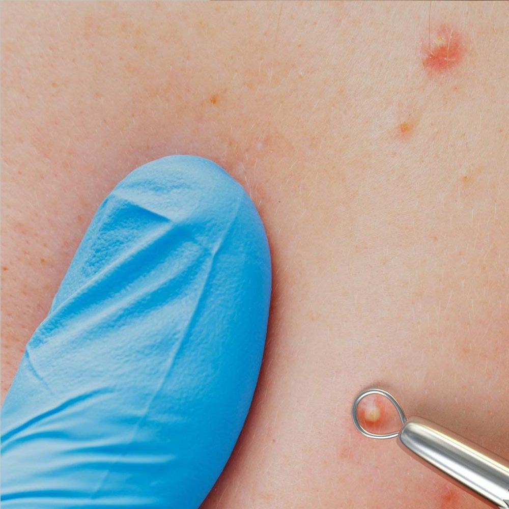 Nástroj na odstraňovanie akné a čiernych bodiek so štandardnou oválnou slučkou a špicatým hrotom