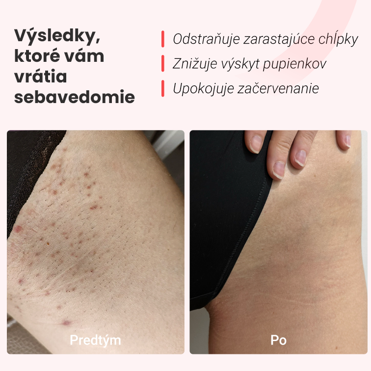 IPL epilátor Hilda